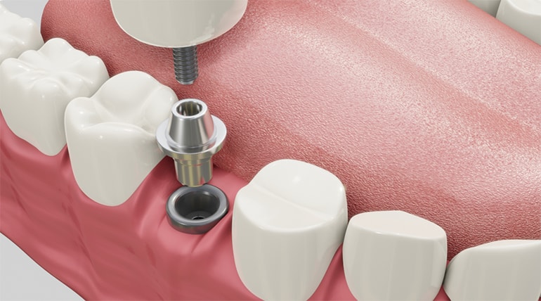 Hagyományos implantáció